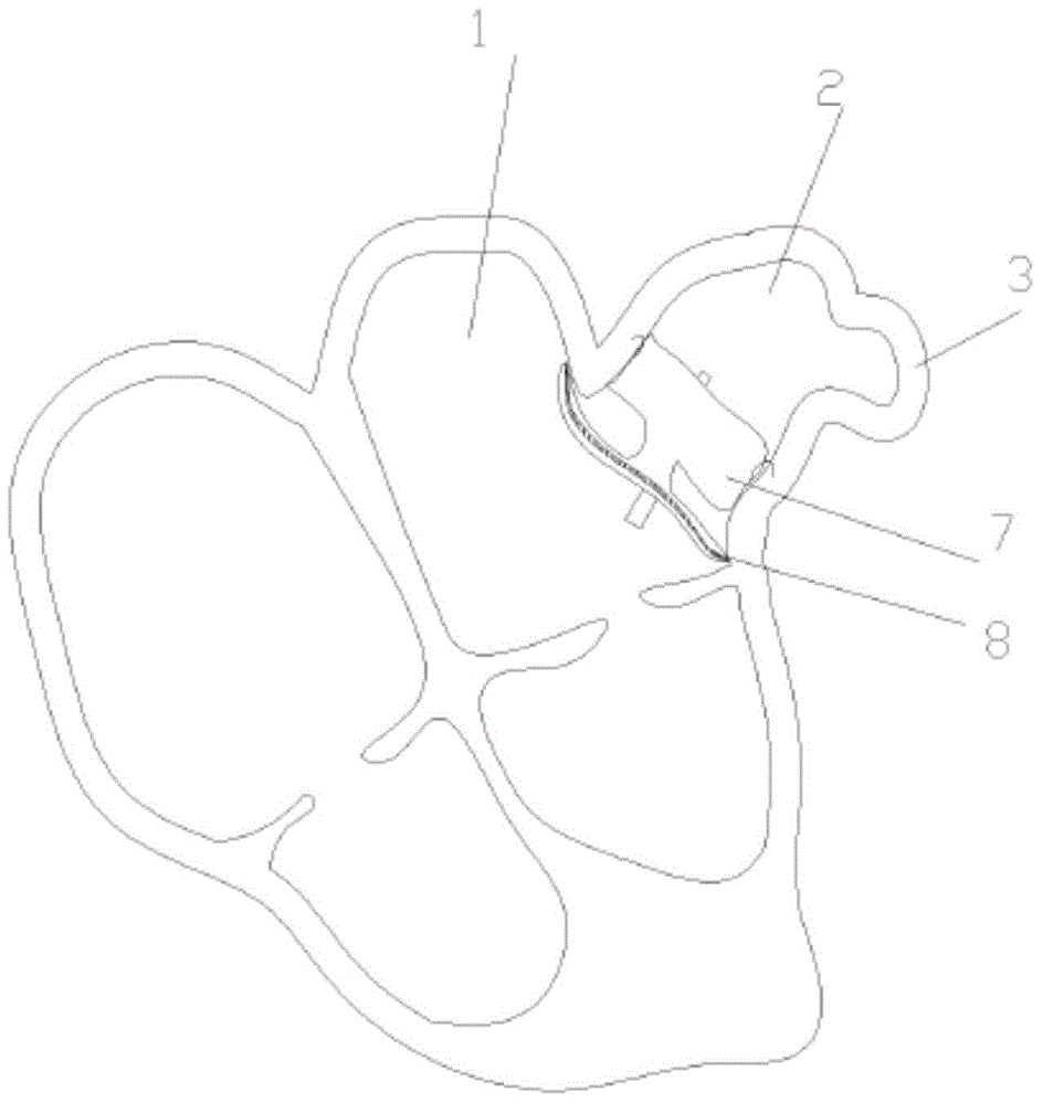 Device for left auricle ligation and using method of device