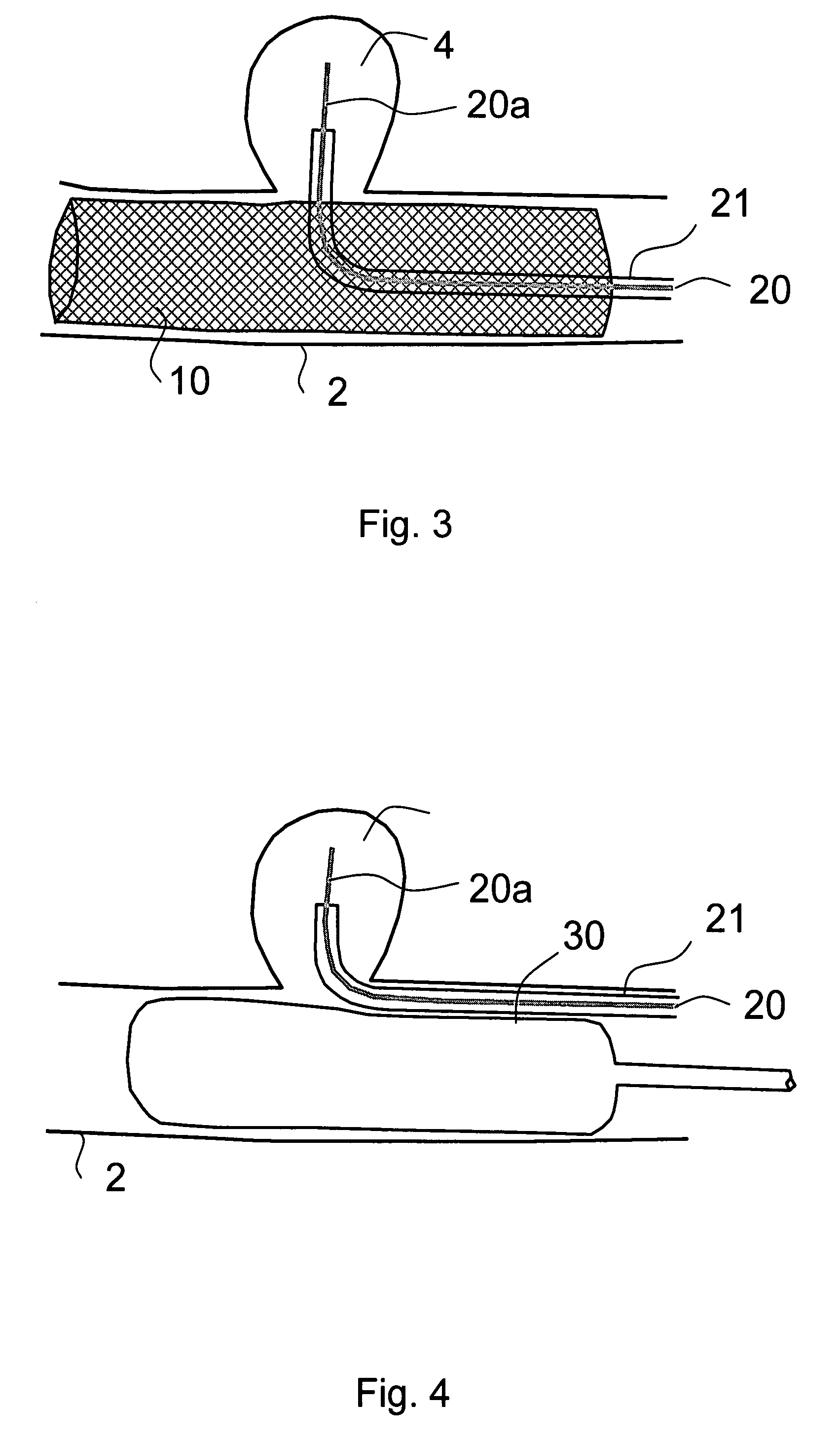 Methods and devices for reducing or blocking blood flow to a selected blood vessel or part thereof