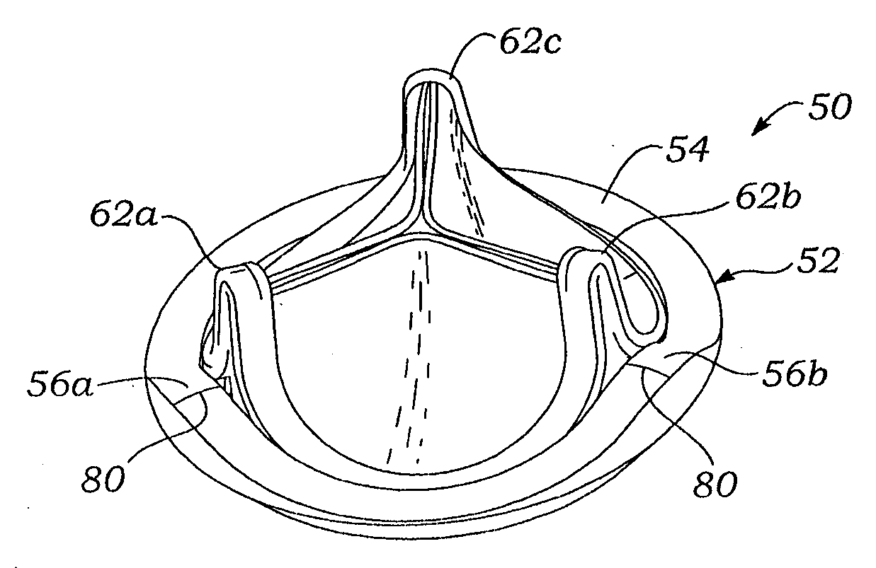 Prosthetic mitral heart valve having a contoured sewing ring