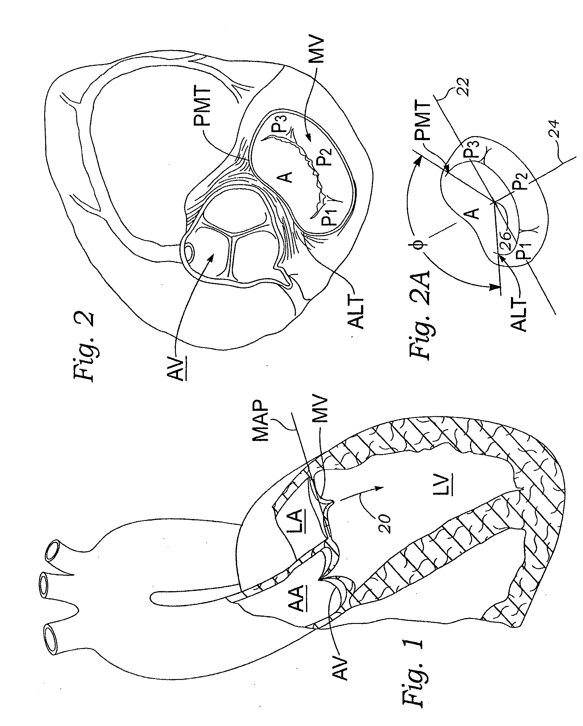 Prosthetic mitral heart valve having a contoured sewing ring