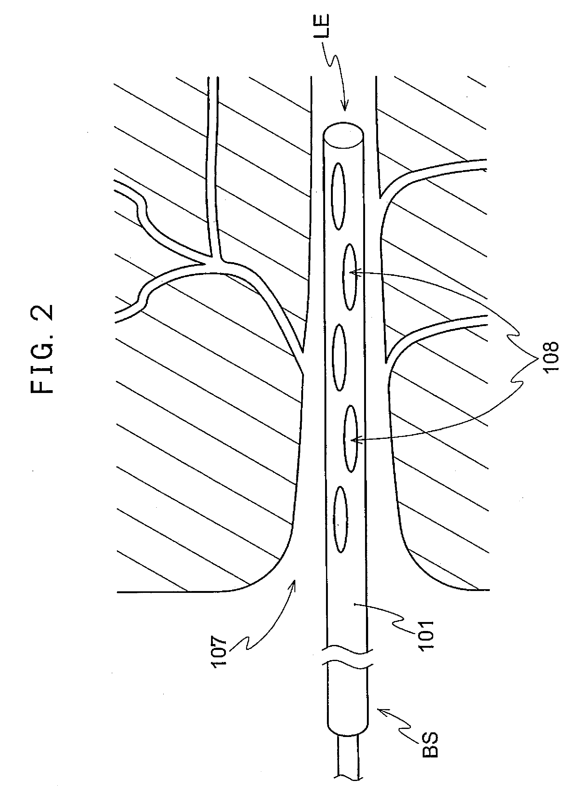 Contrast Agent-Removal System and Method of Activating the Contrast Agent-Removal System