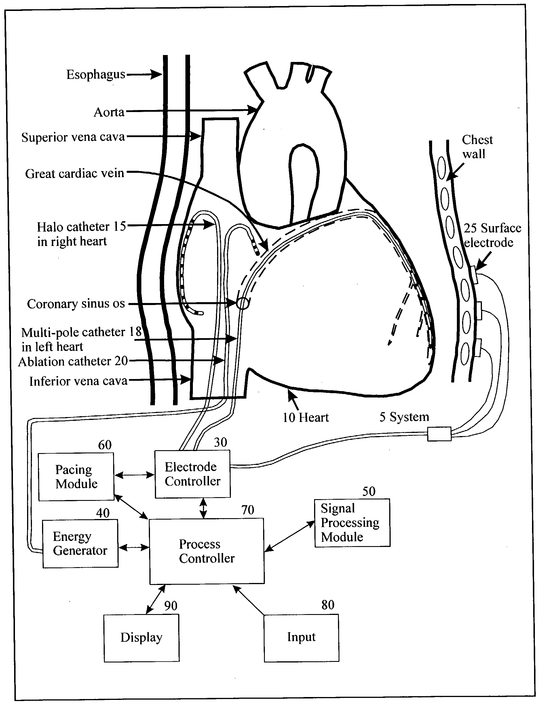 Method and apparatus for classifying and localizing heart arrhythmias