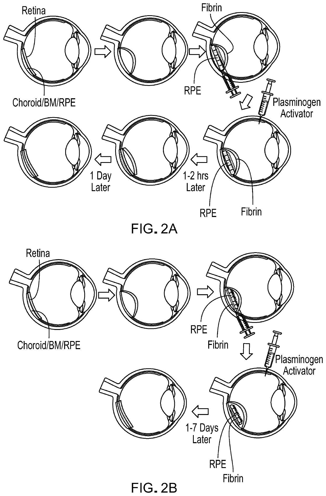 Methods and materials for using fibrin supports for retinal pigment epithelium transplantation