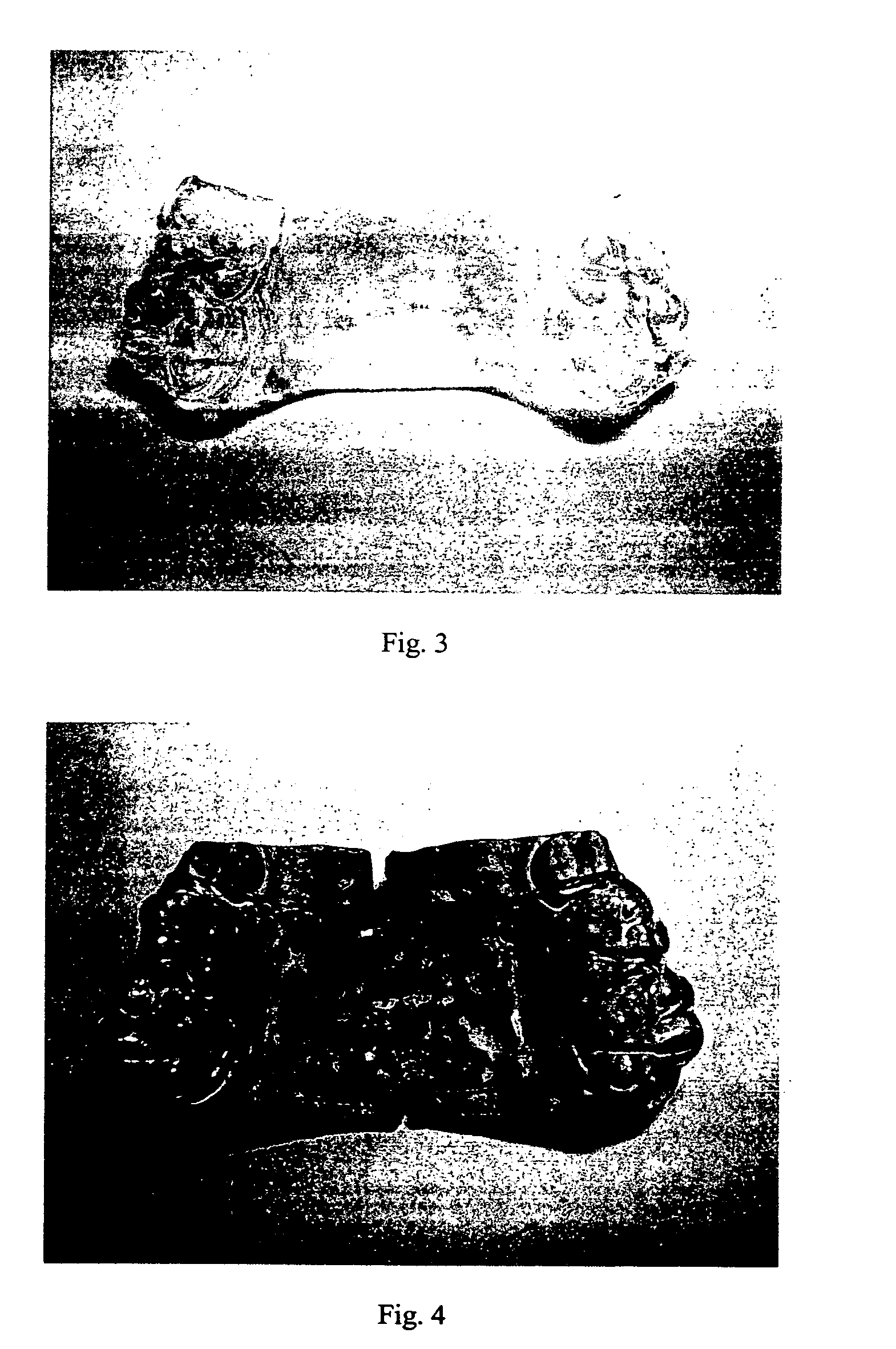 System and method for palatal expansion