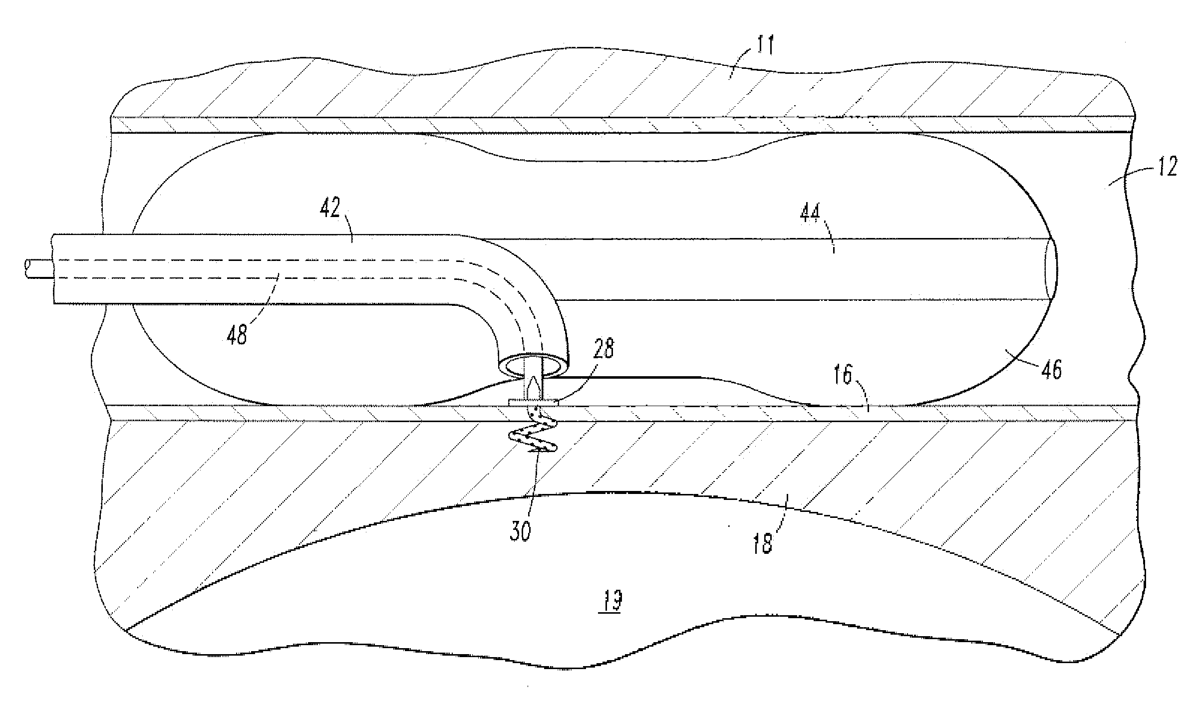 Endovascular cerebrospinal fluid shunt