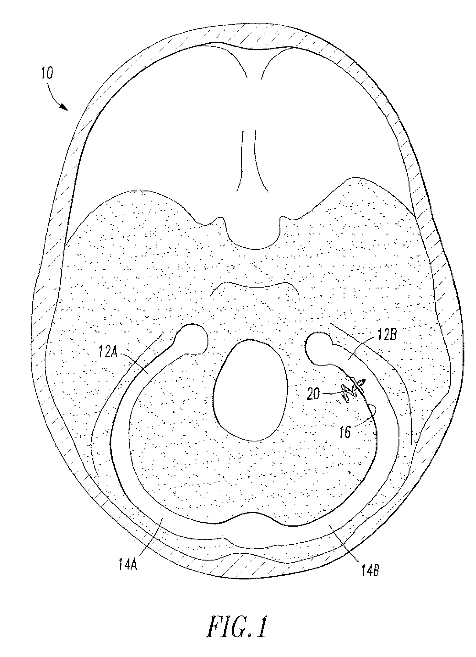 Endovascular cerebrospinal fluid shunt