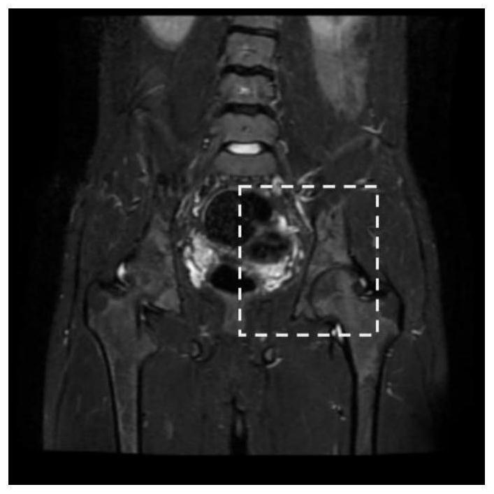 MRI hip joint inflammation segmentation and classification automatic quantitative grading sequential method