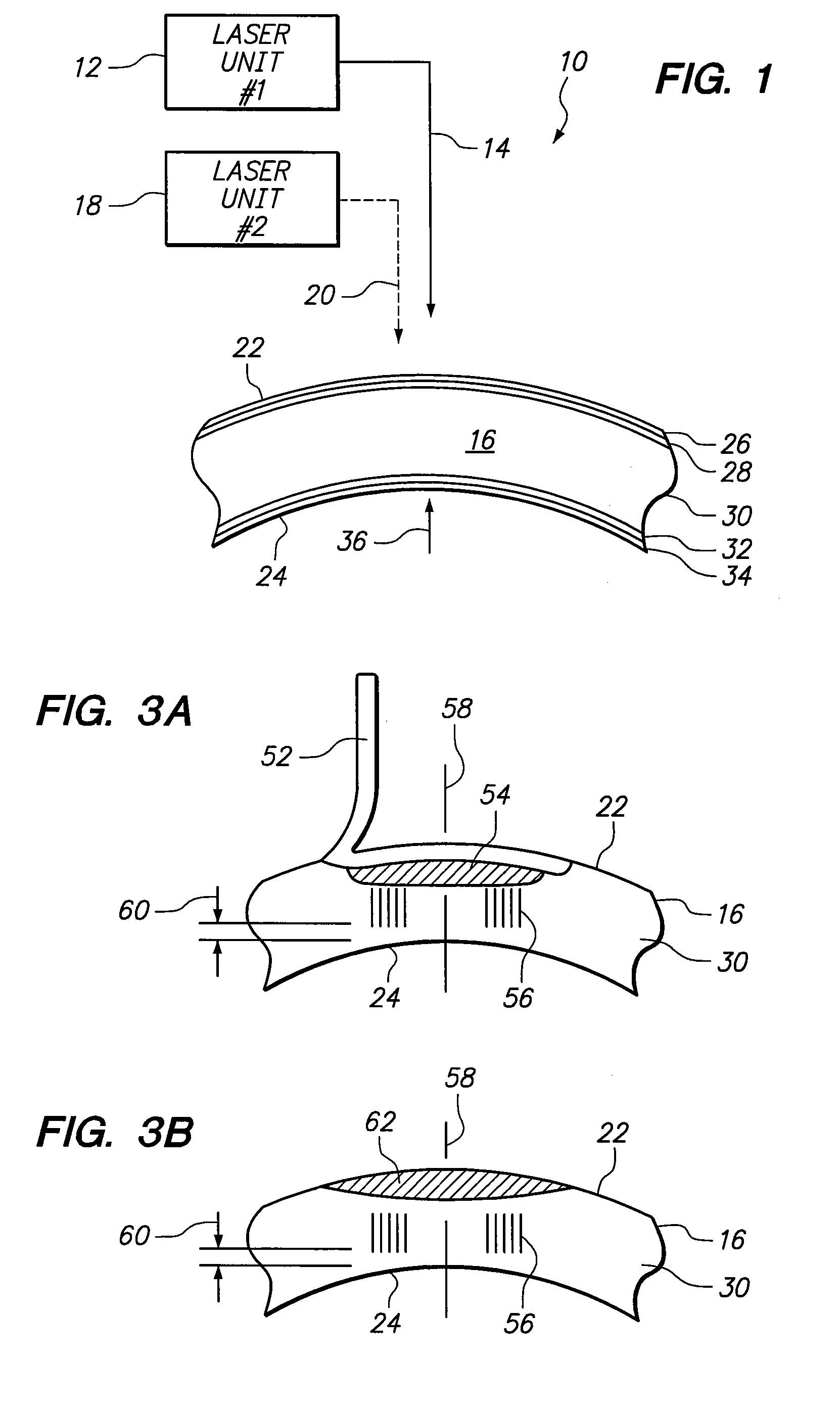 System and Method for Refractive Surgery with Augmentation by Intrastromal Corrective Procedures