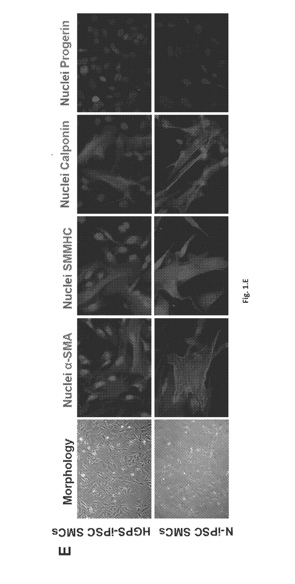 Treatment of hutchinson-gilford progeria syndrome and diseases related to vascular ageing