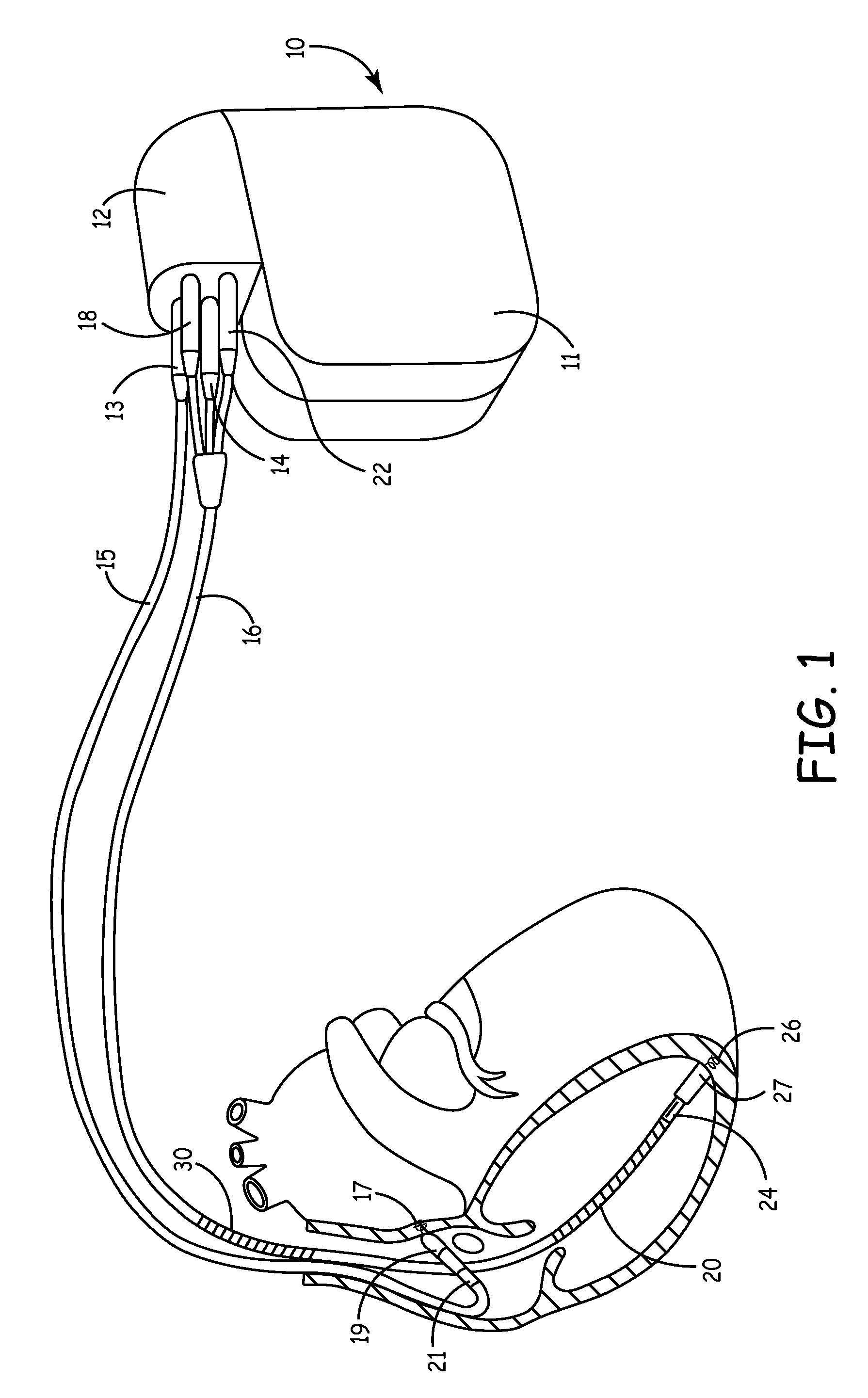 Implantable medical device and method for delivering therapy for sleep-disordered breathing