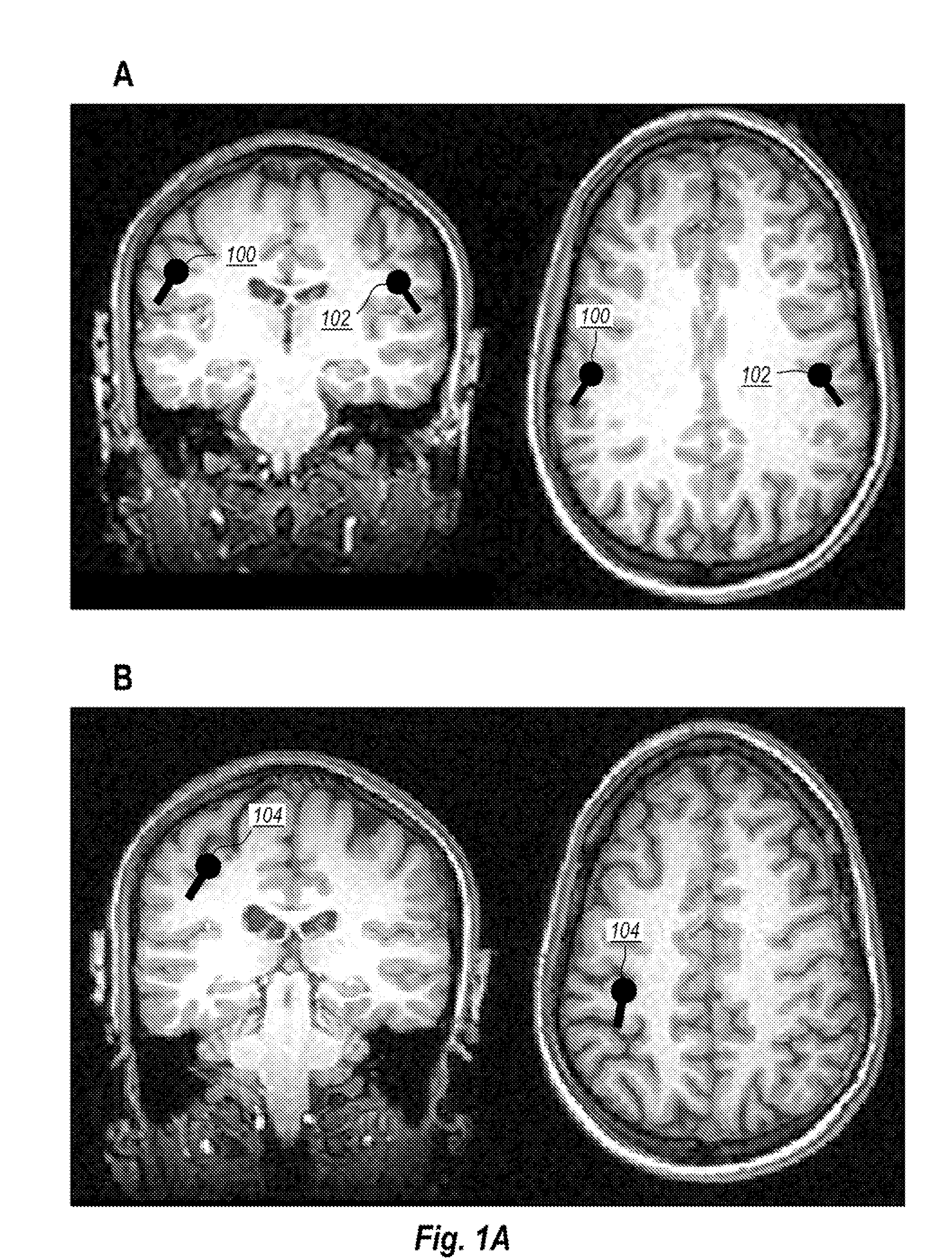 Device, system, and method for mechanosensory nerve ending stimulation