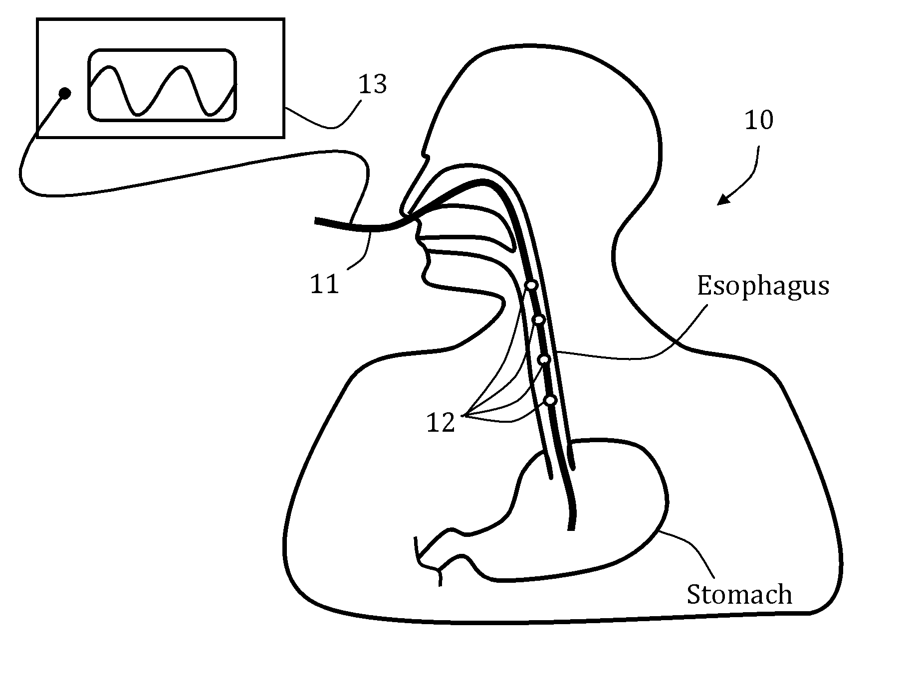 Gi tract stimulation devices and methods