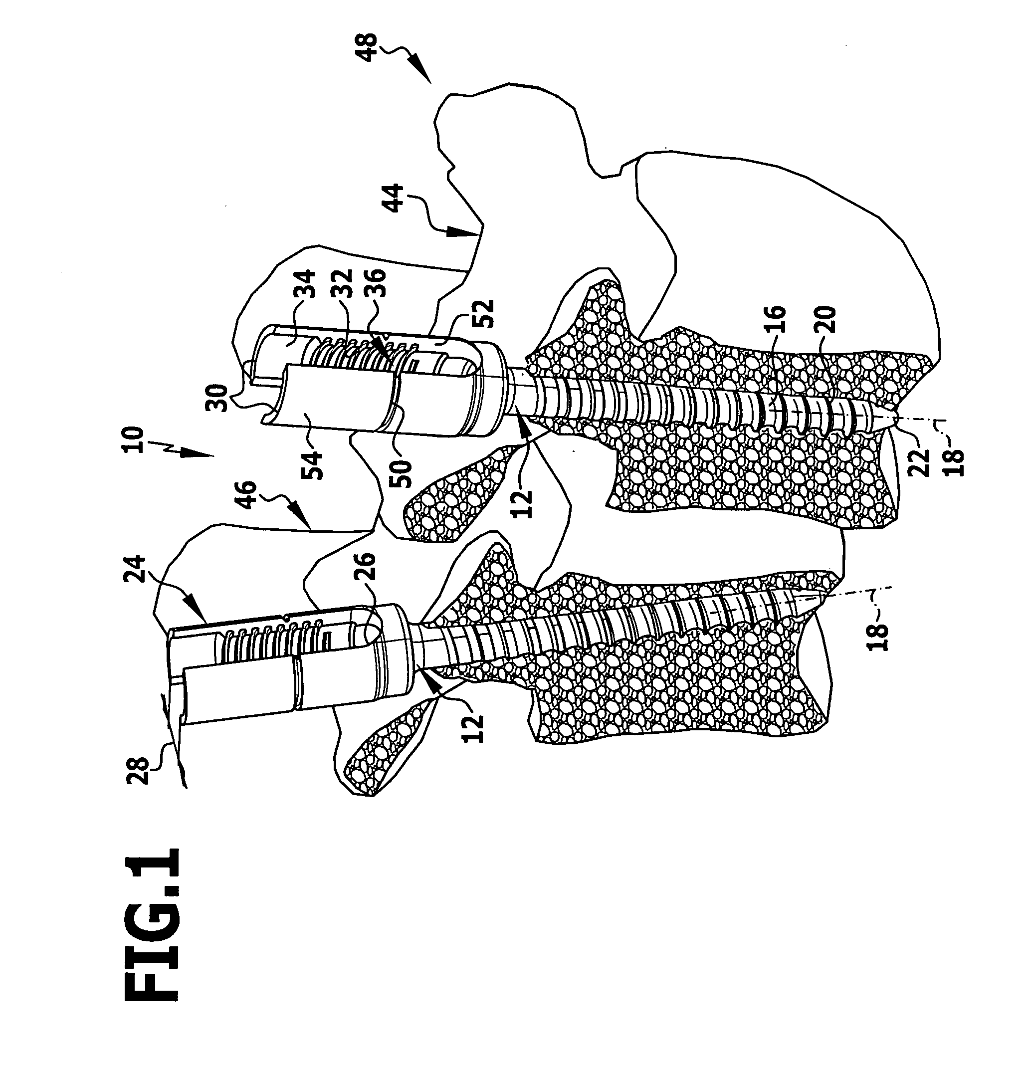 Surgical instrument and osteosynthesis device