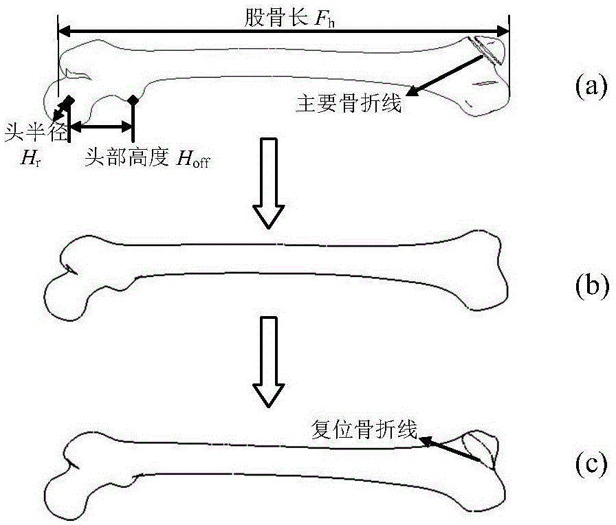 Customized far-end dissect type bone plate design method based on patient femur parameter