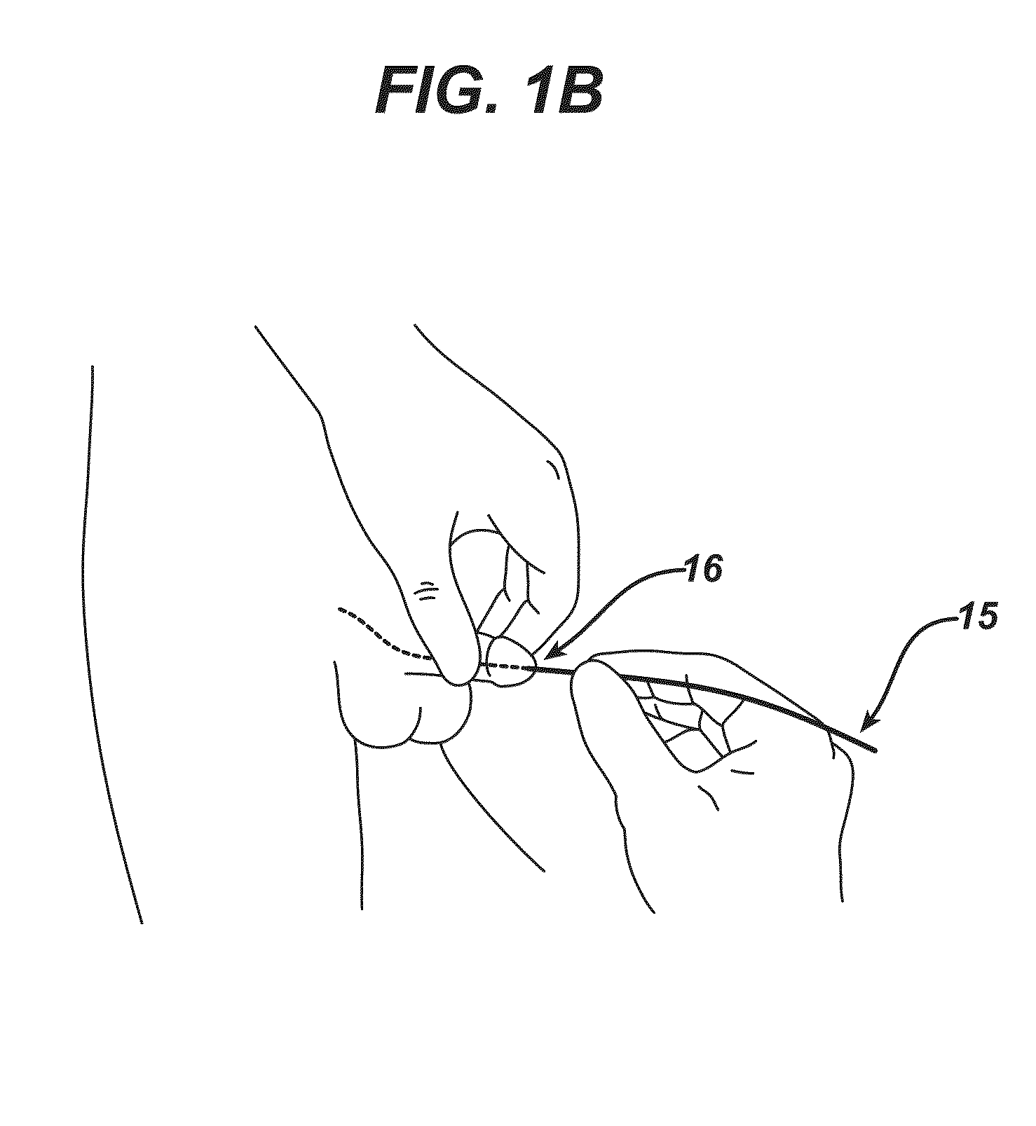 Methods and devices for preventing catheter related urinary tract infections