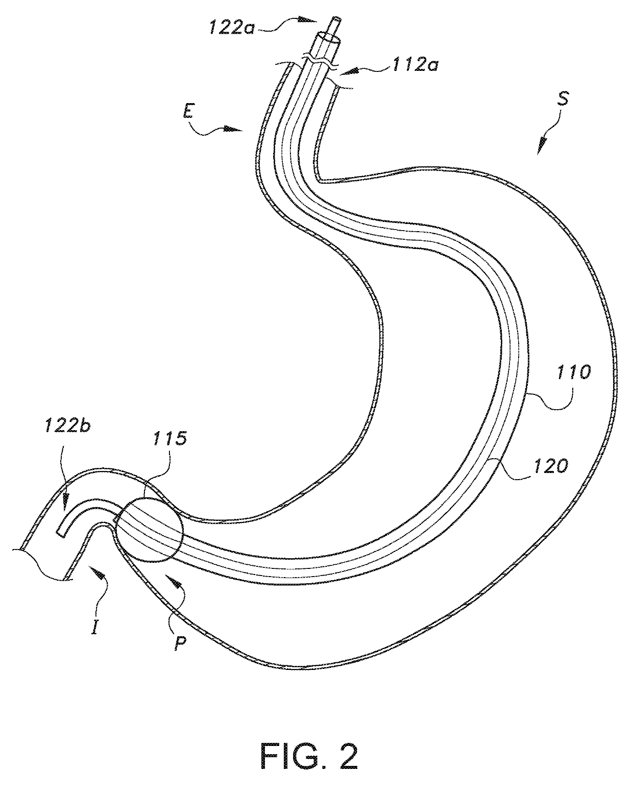 Enteral feeding tube with inflatable cuff