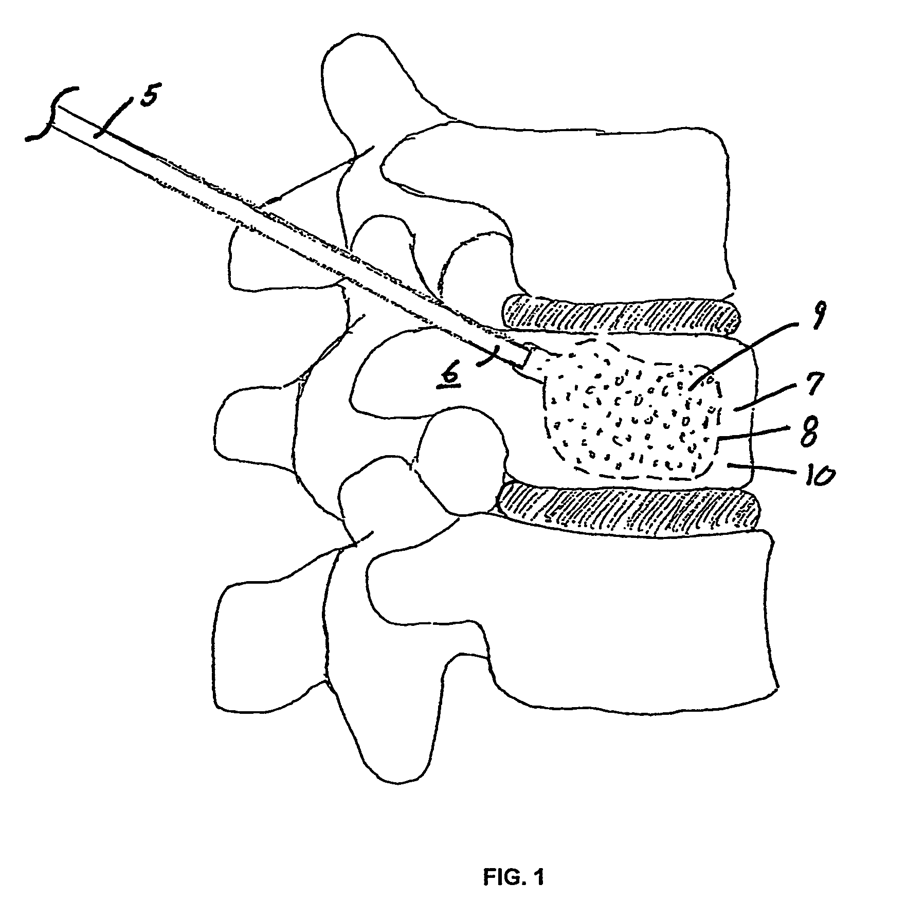 Vertebral augmentation composition and method