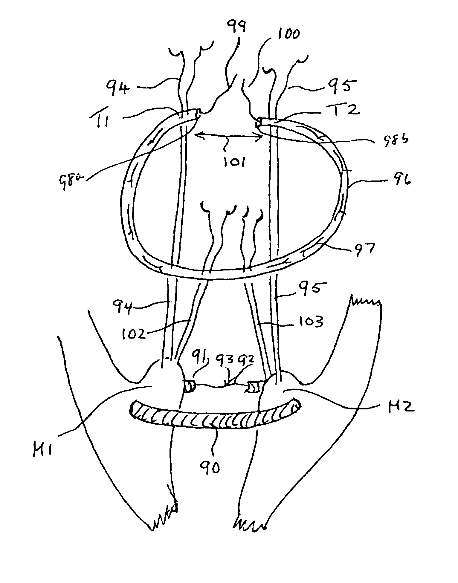 Internal prosthesis for reconstruction of cardiac geometry