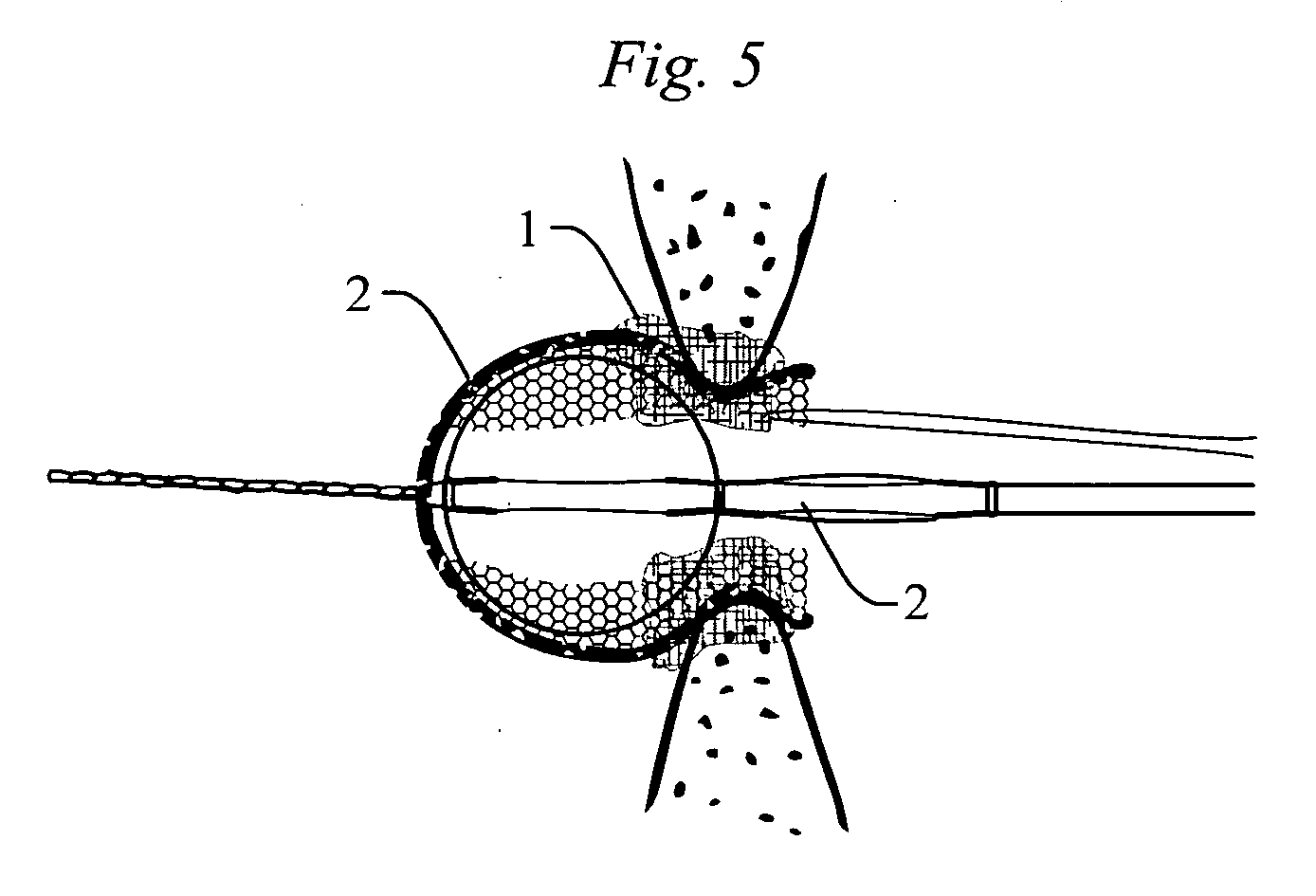 Method and apparatus for occluding a physiological opening