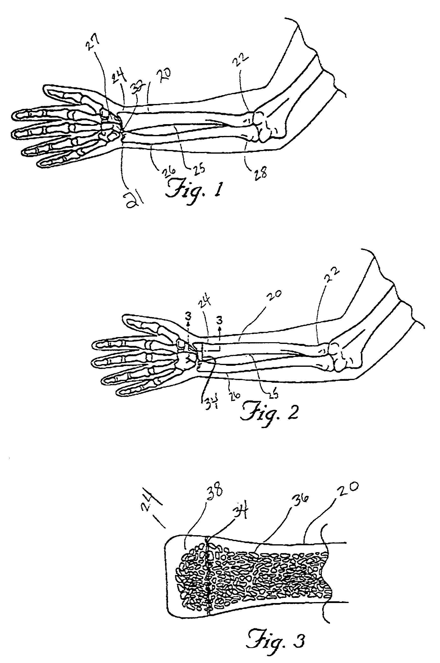 Systems and methods for reducing fractured bone using a fracture reduction cannula