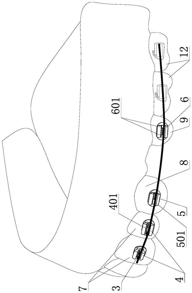 An orthodontic self-ligating bracket system with an open auxiliary groove