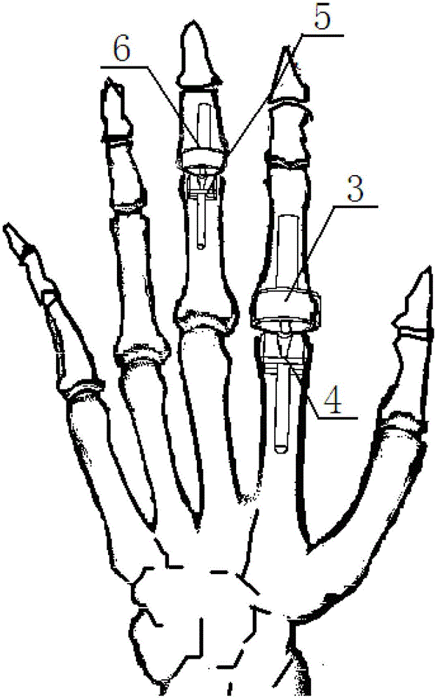 A magnetic joint prosthesis