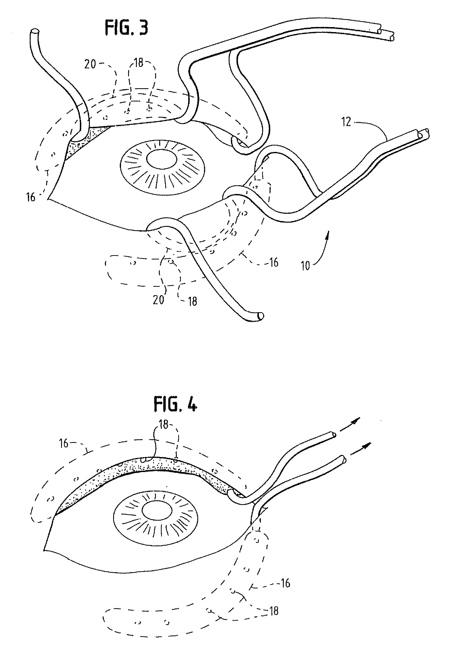 Ophthalmic sulcus speculum