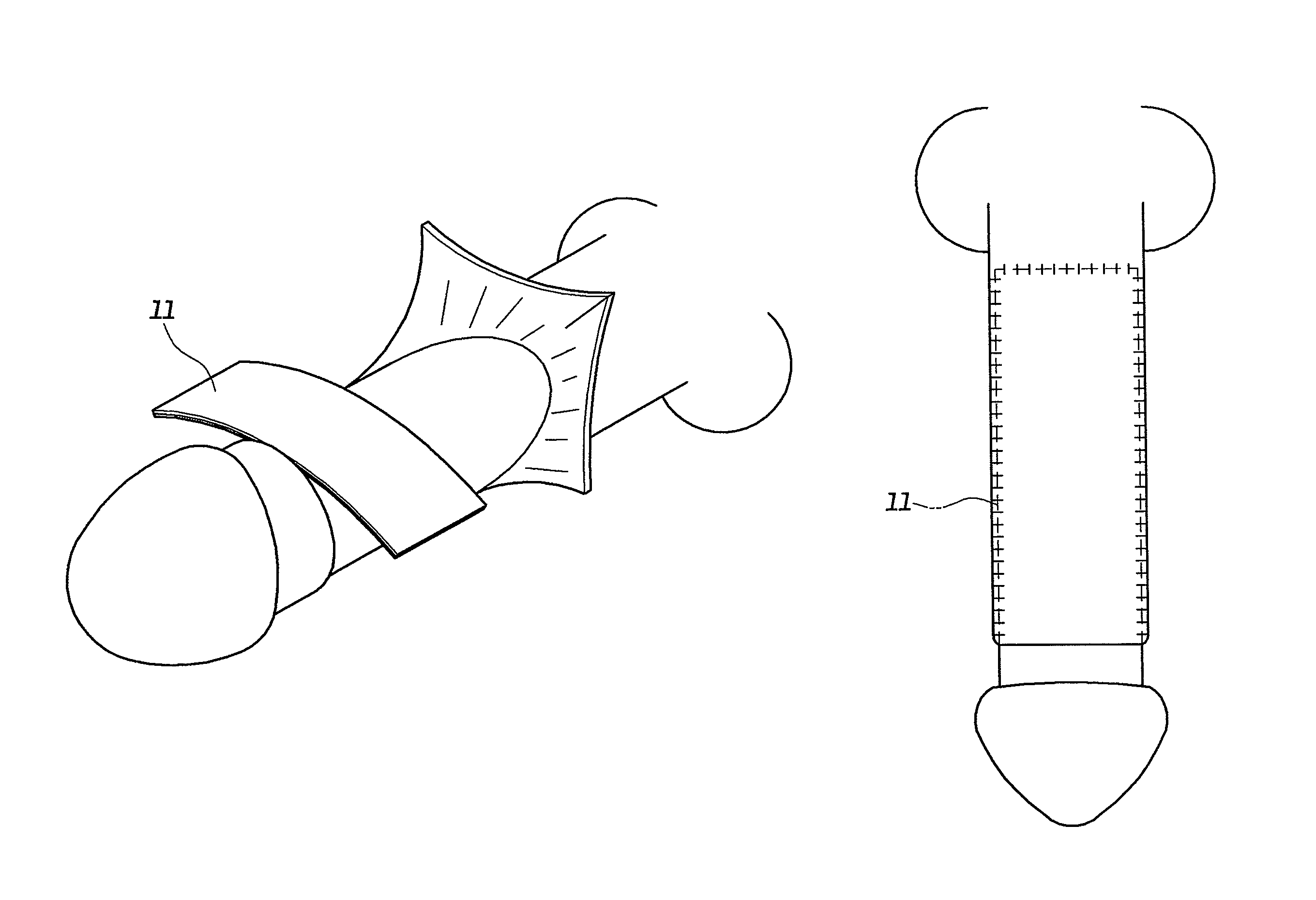 Method for complex phaloplasty using circumcised foreskin as autograft