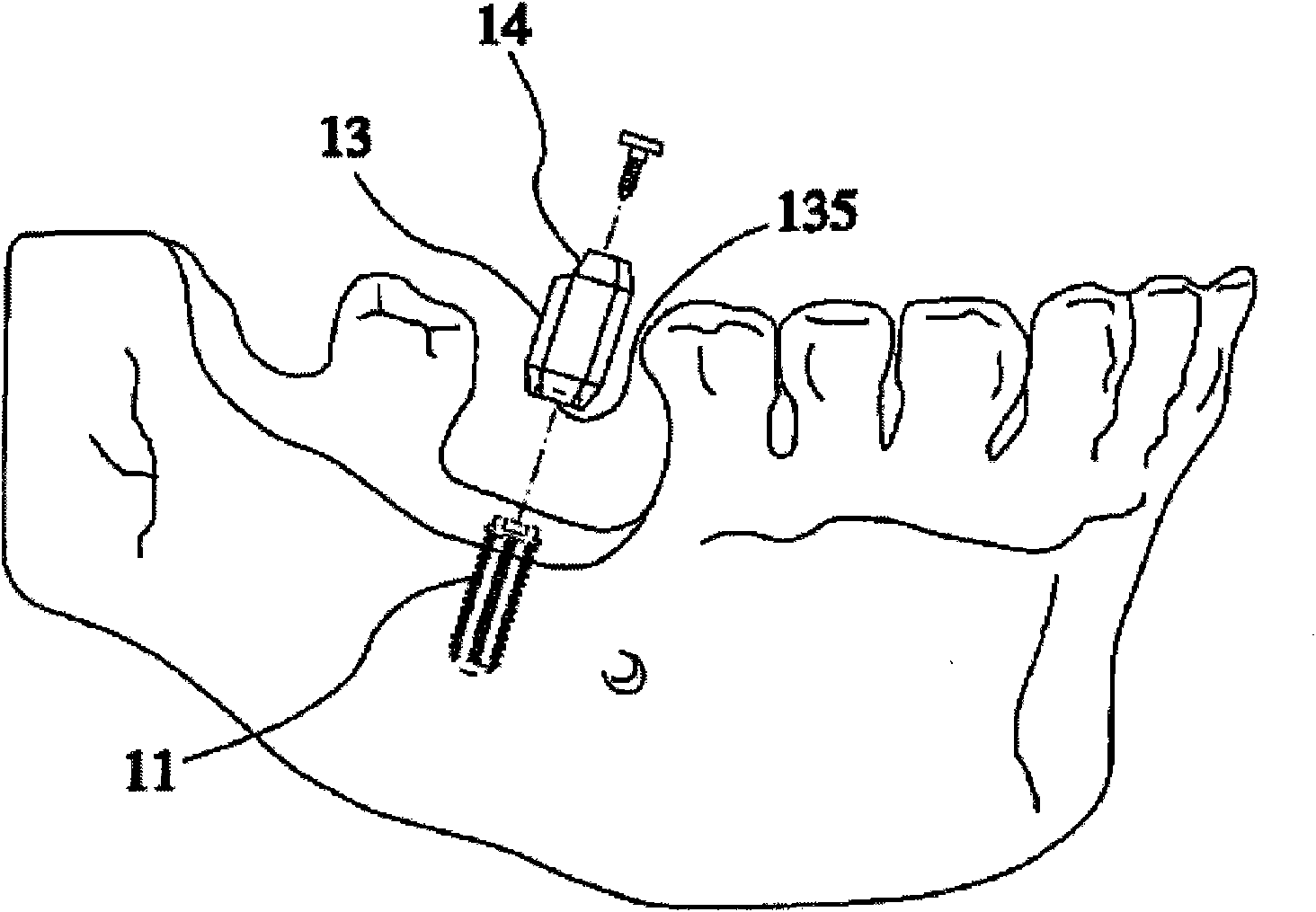 Method for designing implant prosthesis