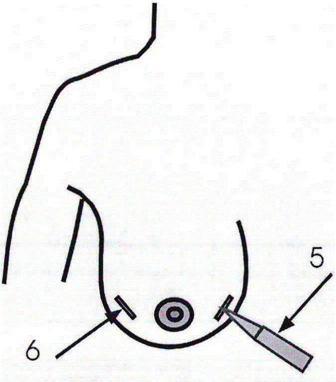 Minimally-invasive breast in-vivo implantation device system and tool combination