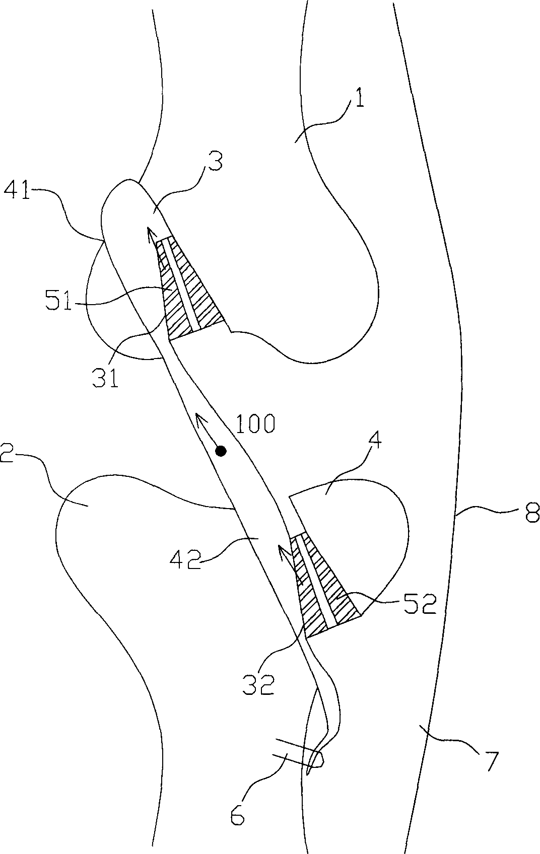 Reverse squeezing fixing method and device for ligament
