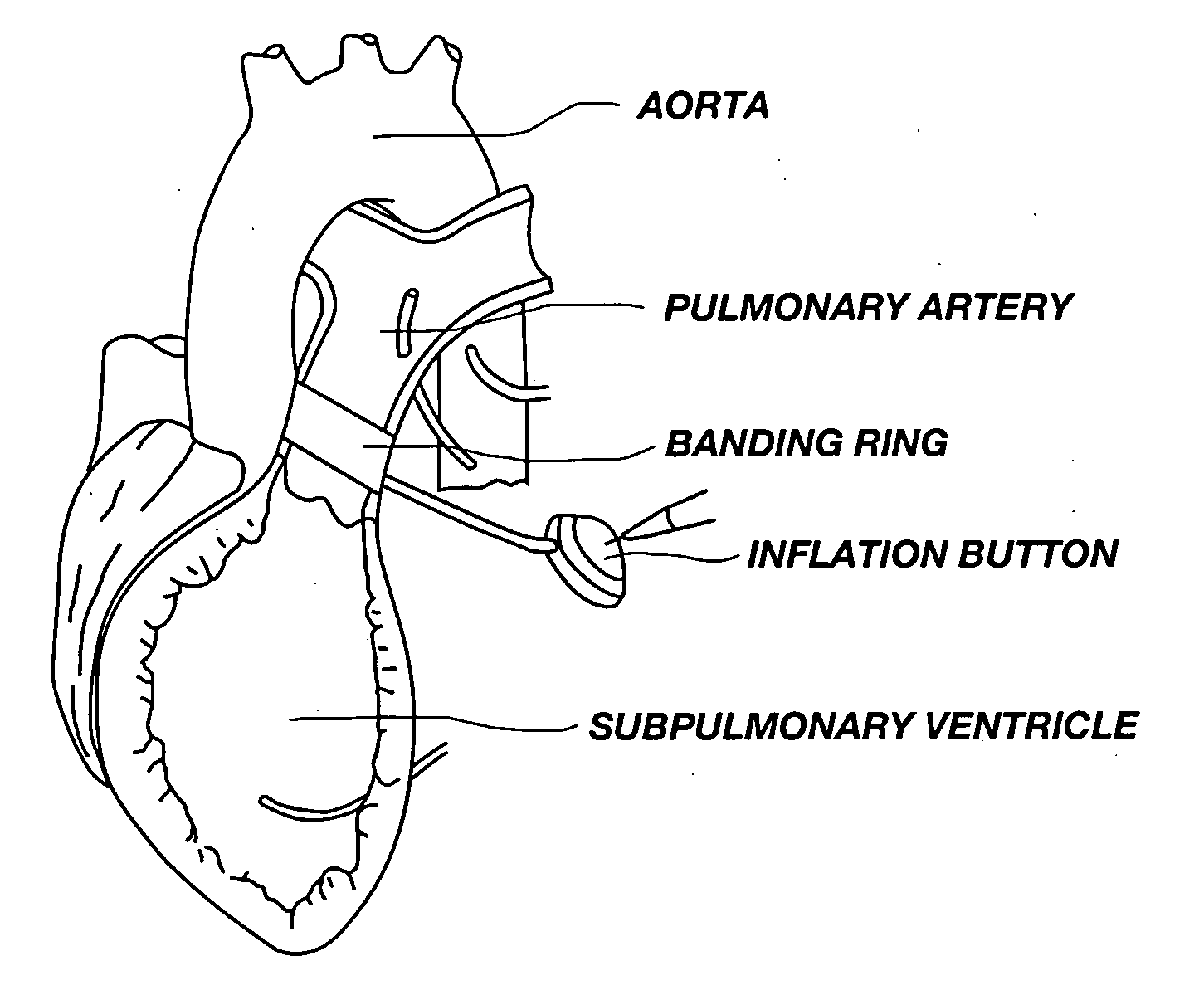 Pulmonary artery banding device