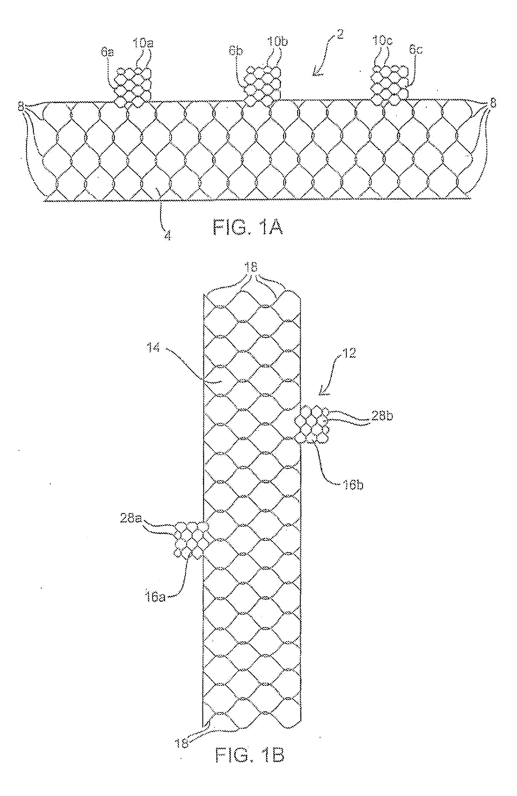 Apparatus and method for deploying an implantable device within the body