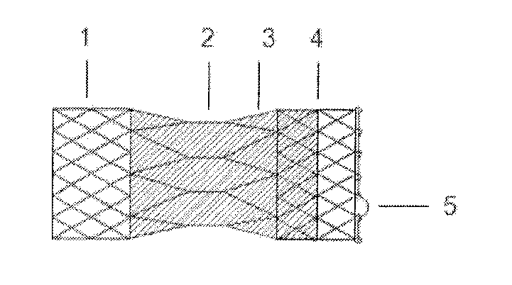 Recyclable and adjustable interventional stent for intravascular constriction