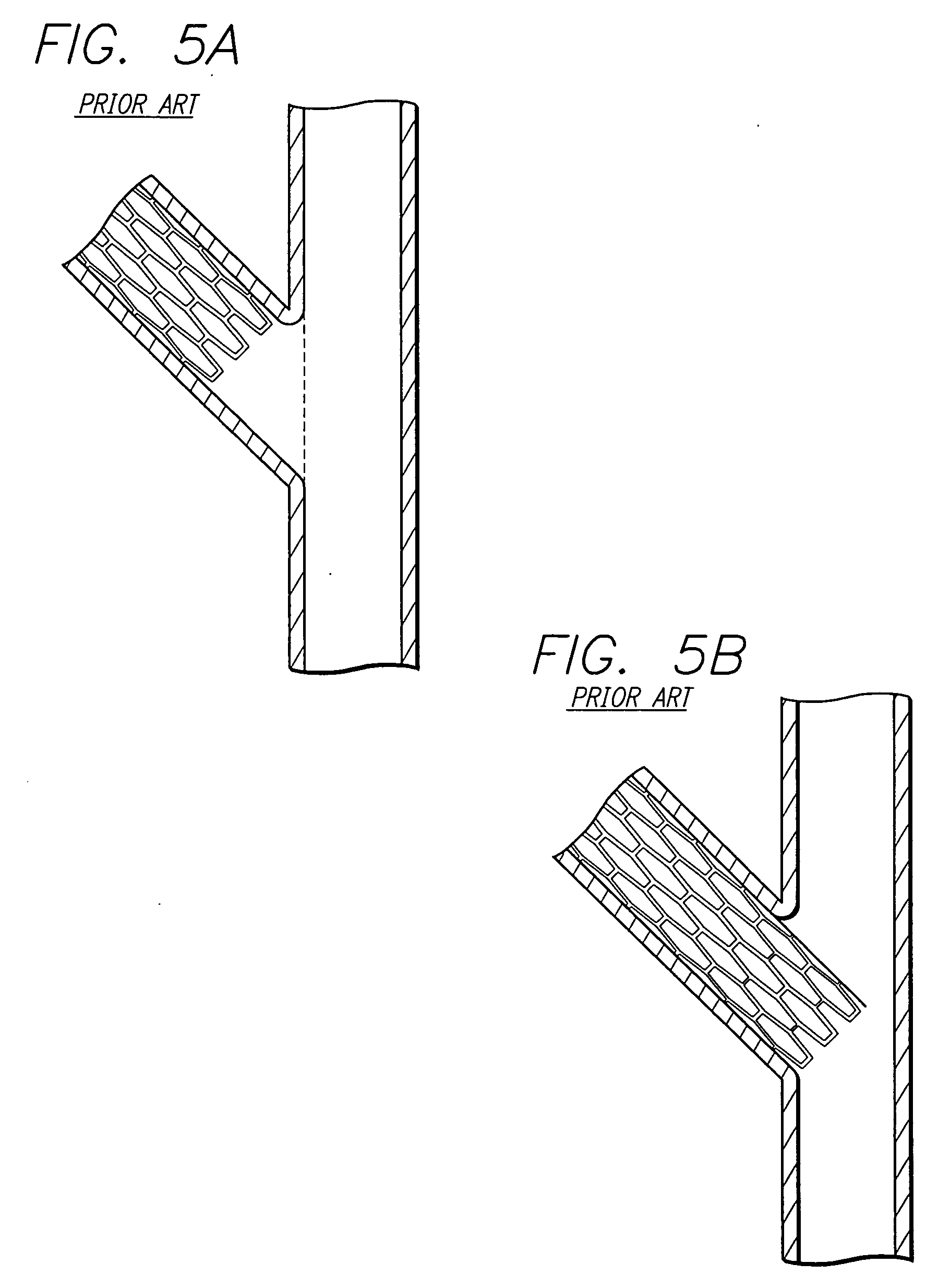 Catheter assembly and method for treating bifurcations