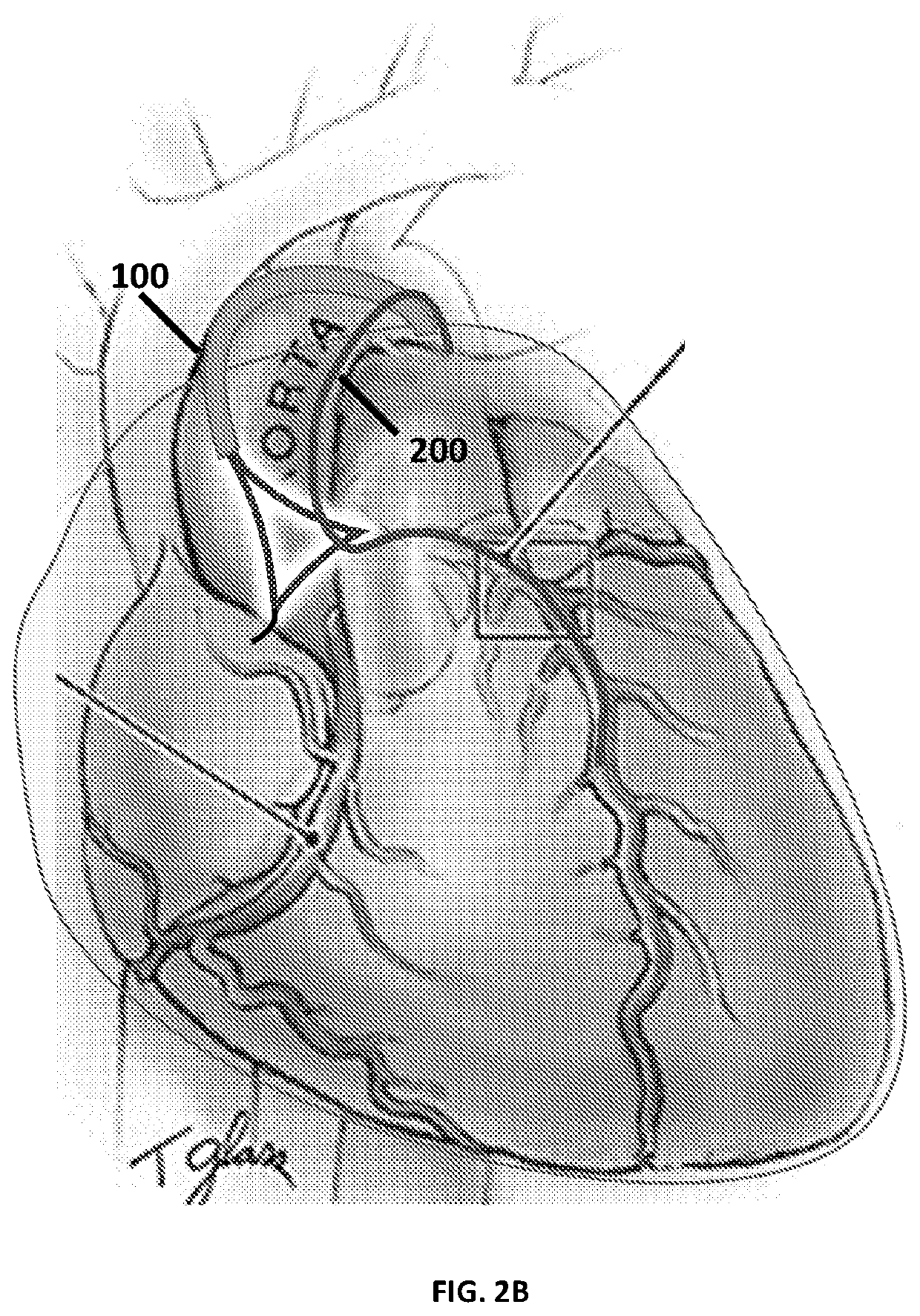 Methods and devices for minimally invasive transcatheter coronary artery bypass grafting
