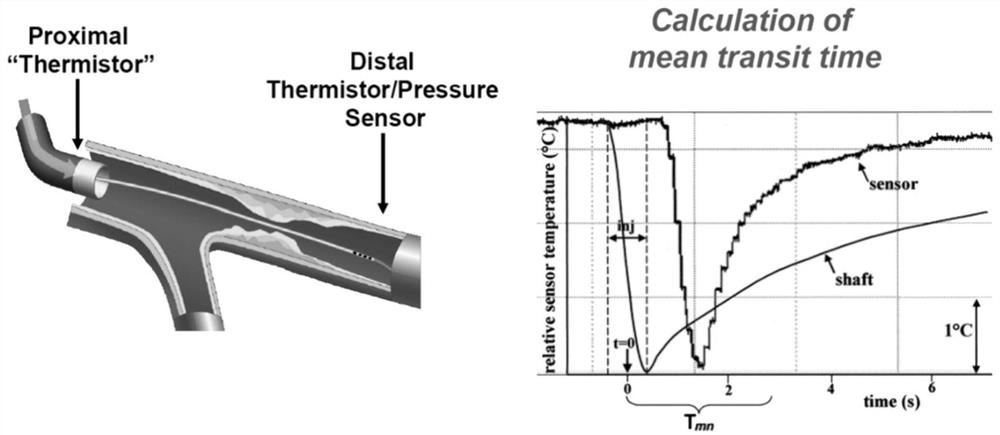 Noninvasive coronary artery microcirculation detection method based on myocardial perfusion