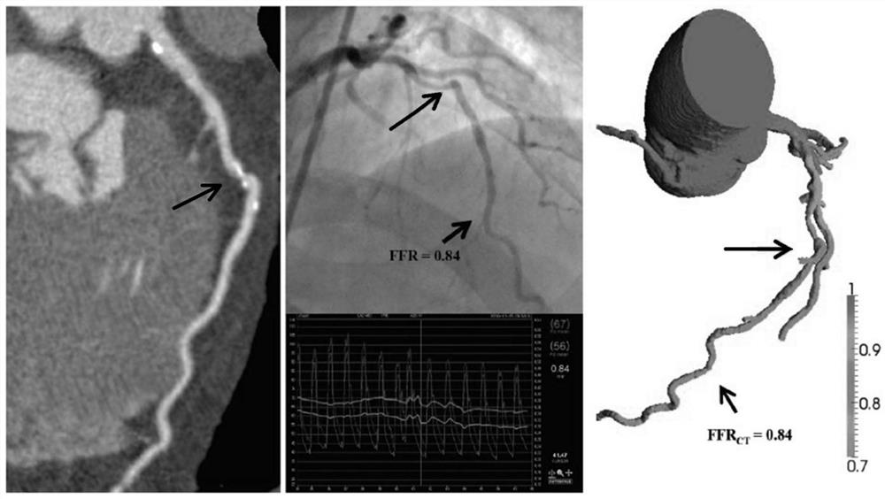 Noninvasive coronary artery microcirculation detection method based on myocardial perfusion