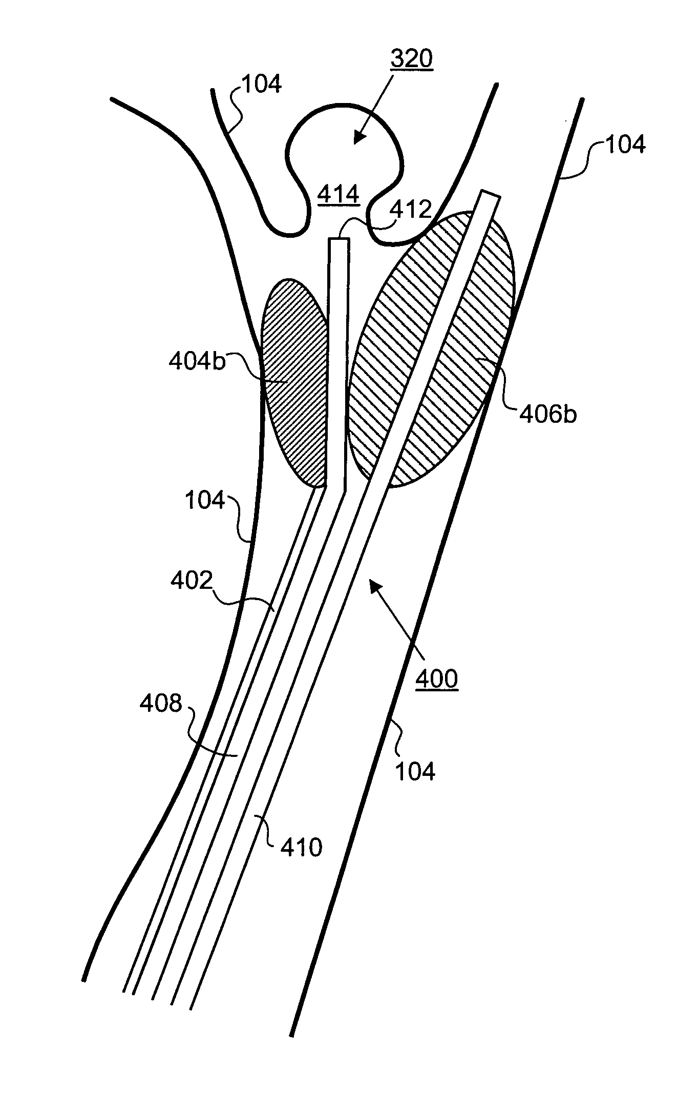 Balloon assisted occlusion of aneurysms