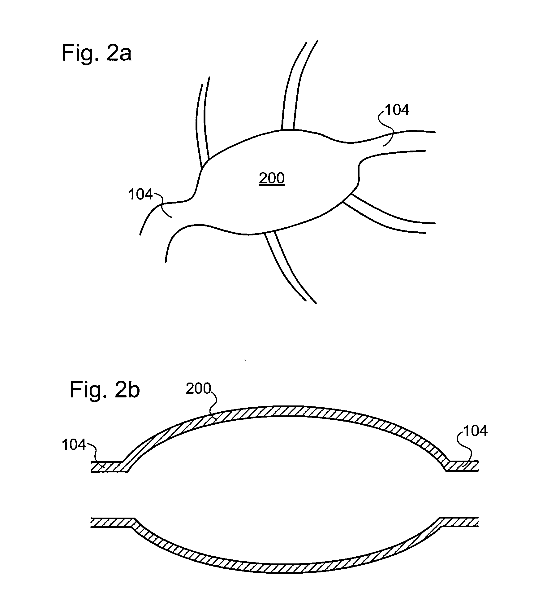 Balloon assisted occlusion of aneurysms