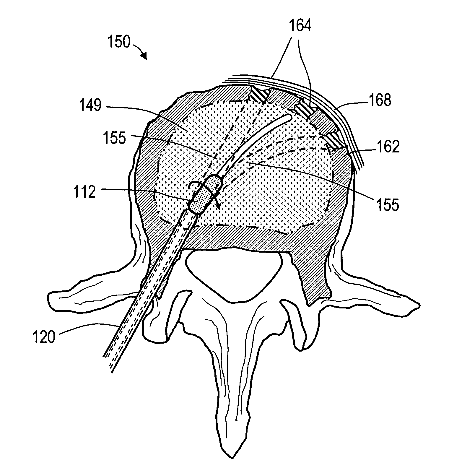 Bone treatment systems and methods for introducing an abrading structure to abrade bone