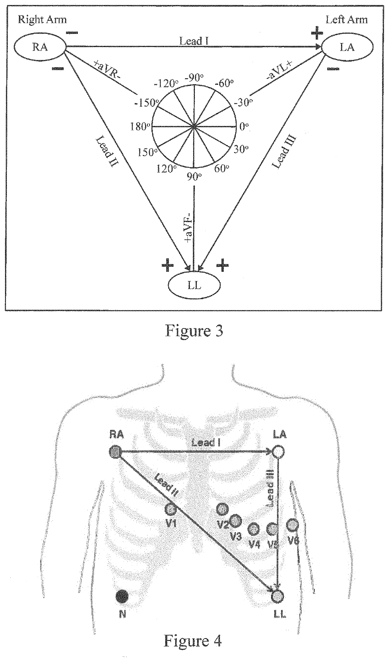 Method and device for monitoring left ventricular hypertrophy and calculating defibrillation thresholds