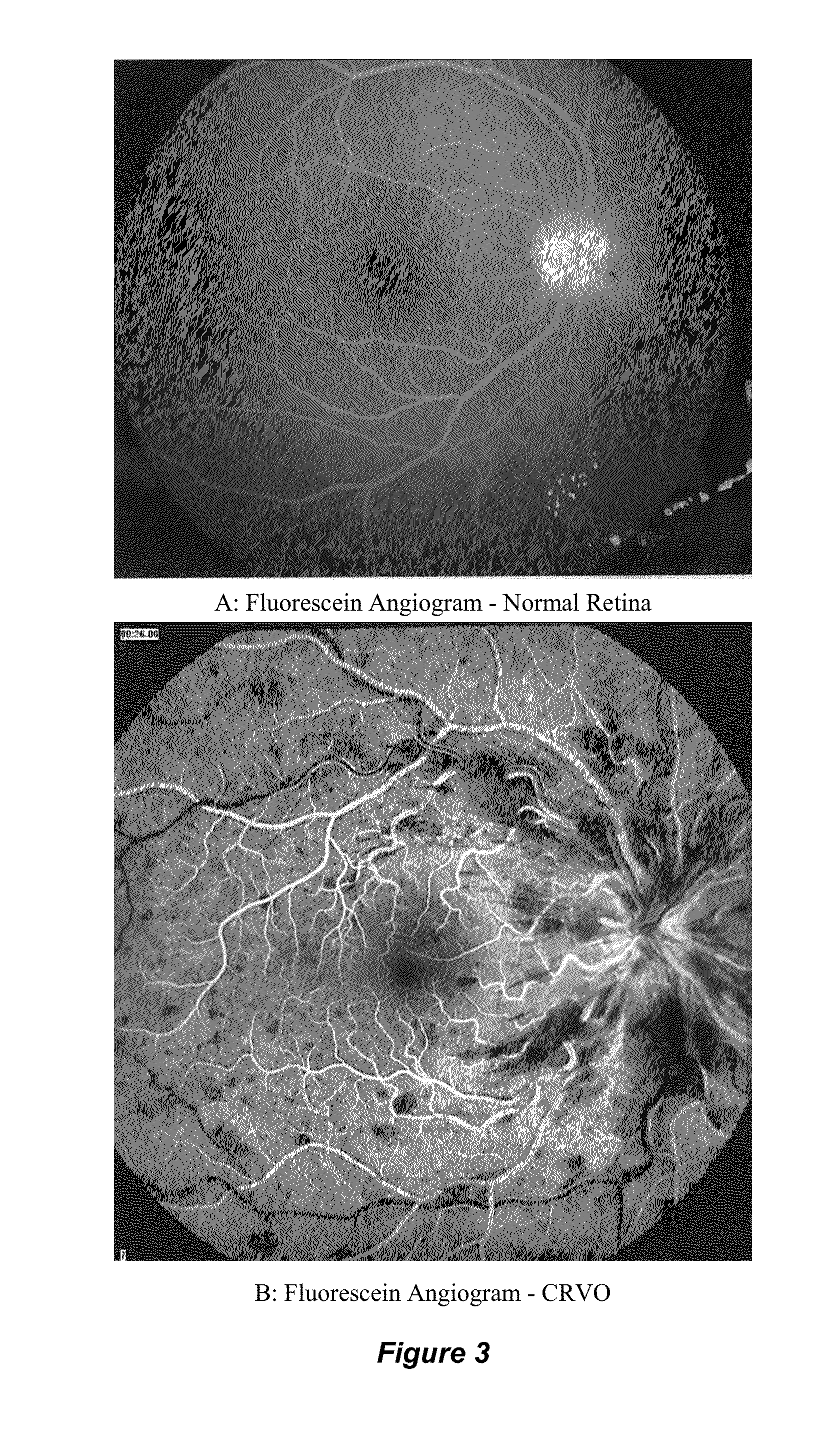 Methods, apparatus, and compounds for the treatment of central retinal vein occlusion and other conditions