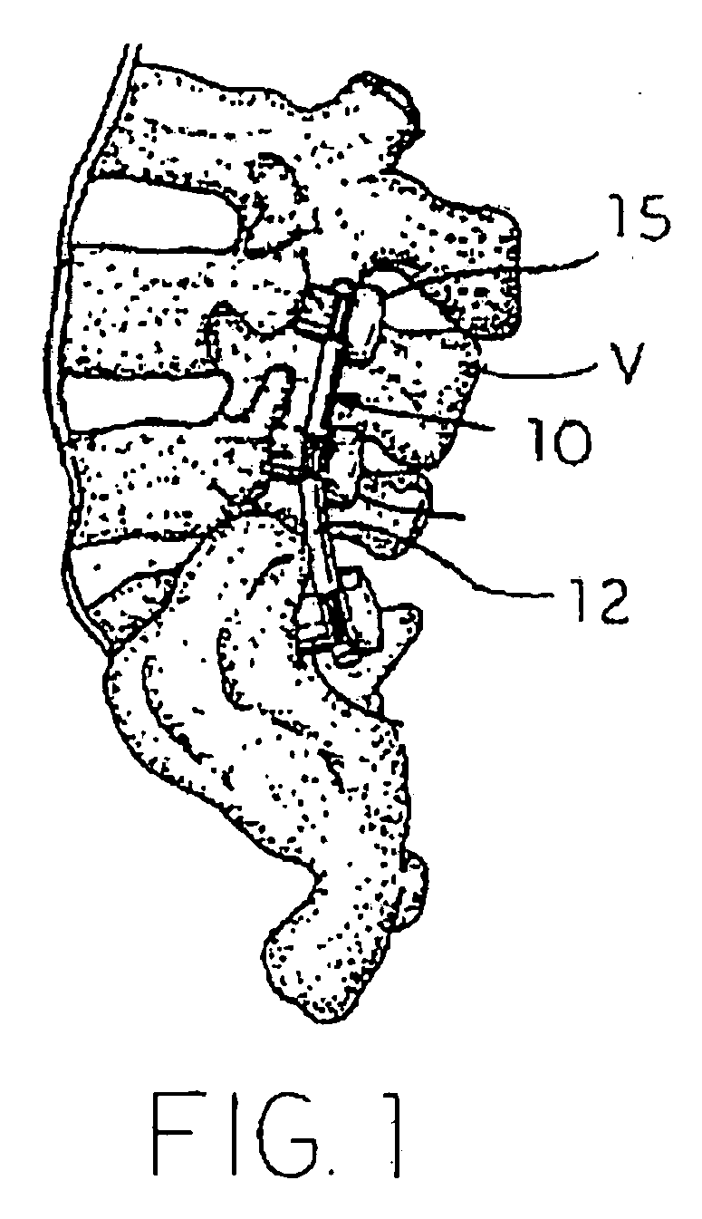 Multi-Axial Spinal Fixation System