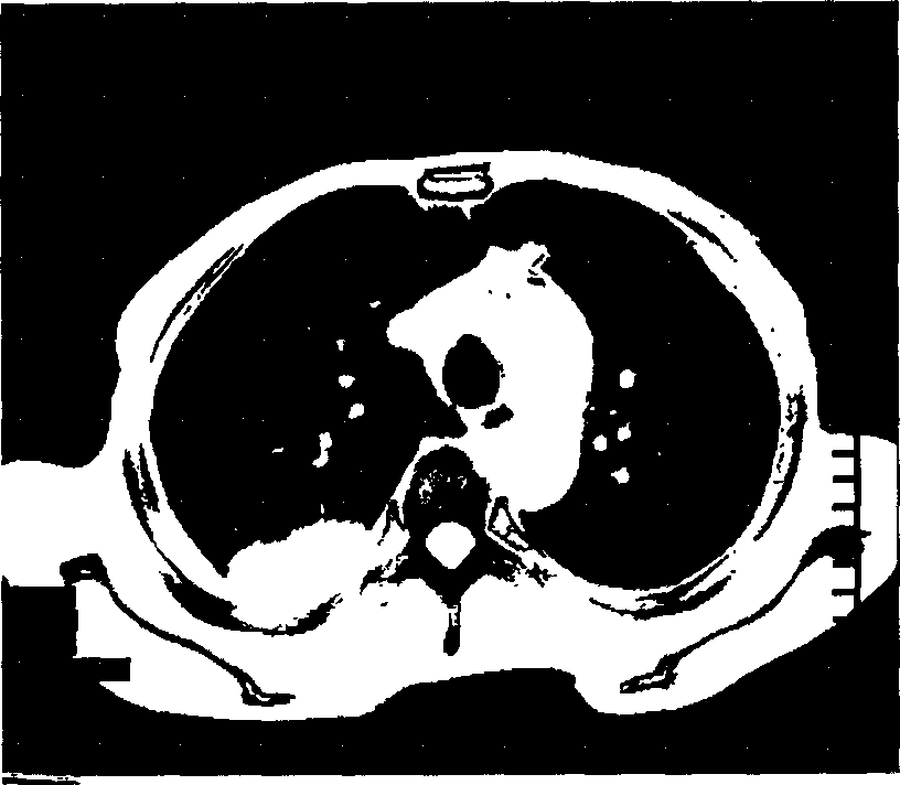 Automatic generating method for colour multi-window CT image