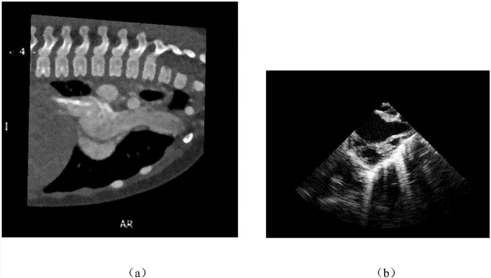 Cardiac CT and ultrasound image registration method based on salient region area matching