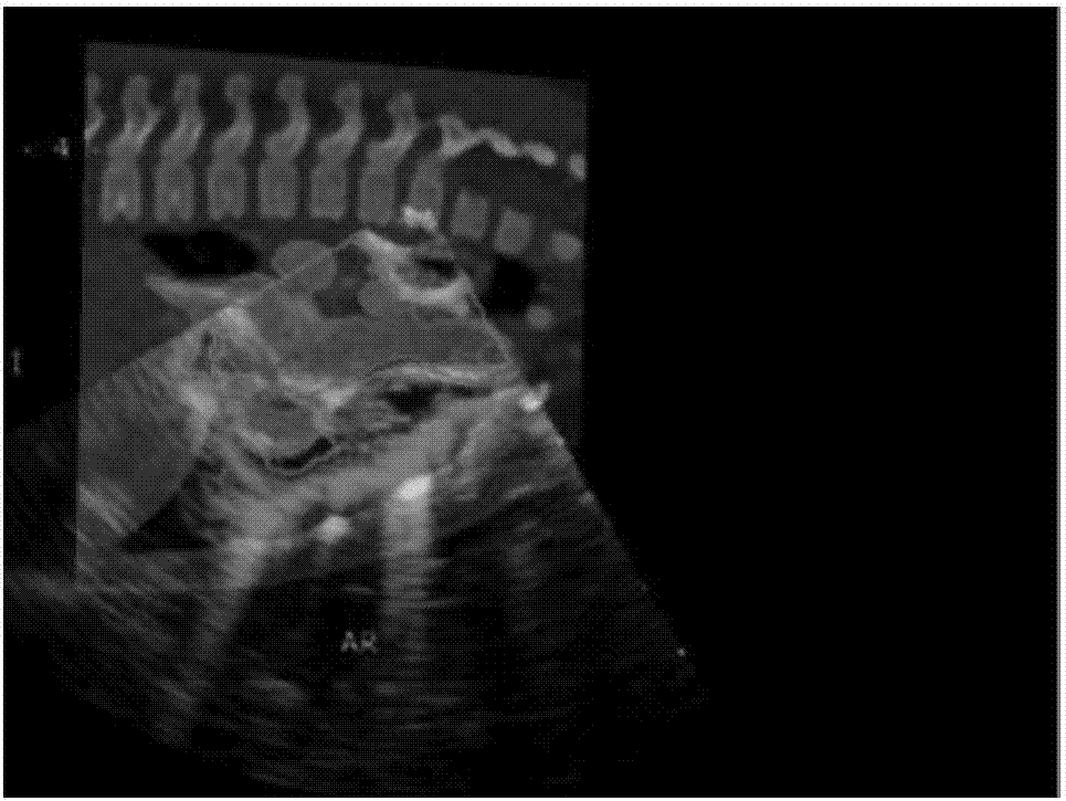 Cardiac CT and ultrasound image registration method based on salient region area matching