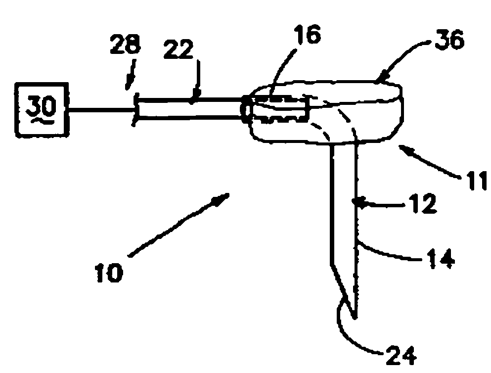 Apparatus and methods useful for monitoring intraocular pressure