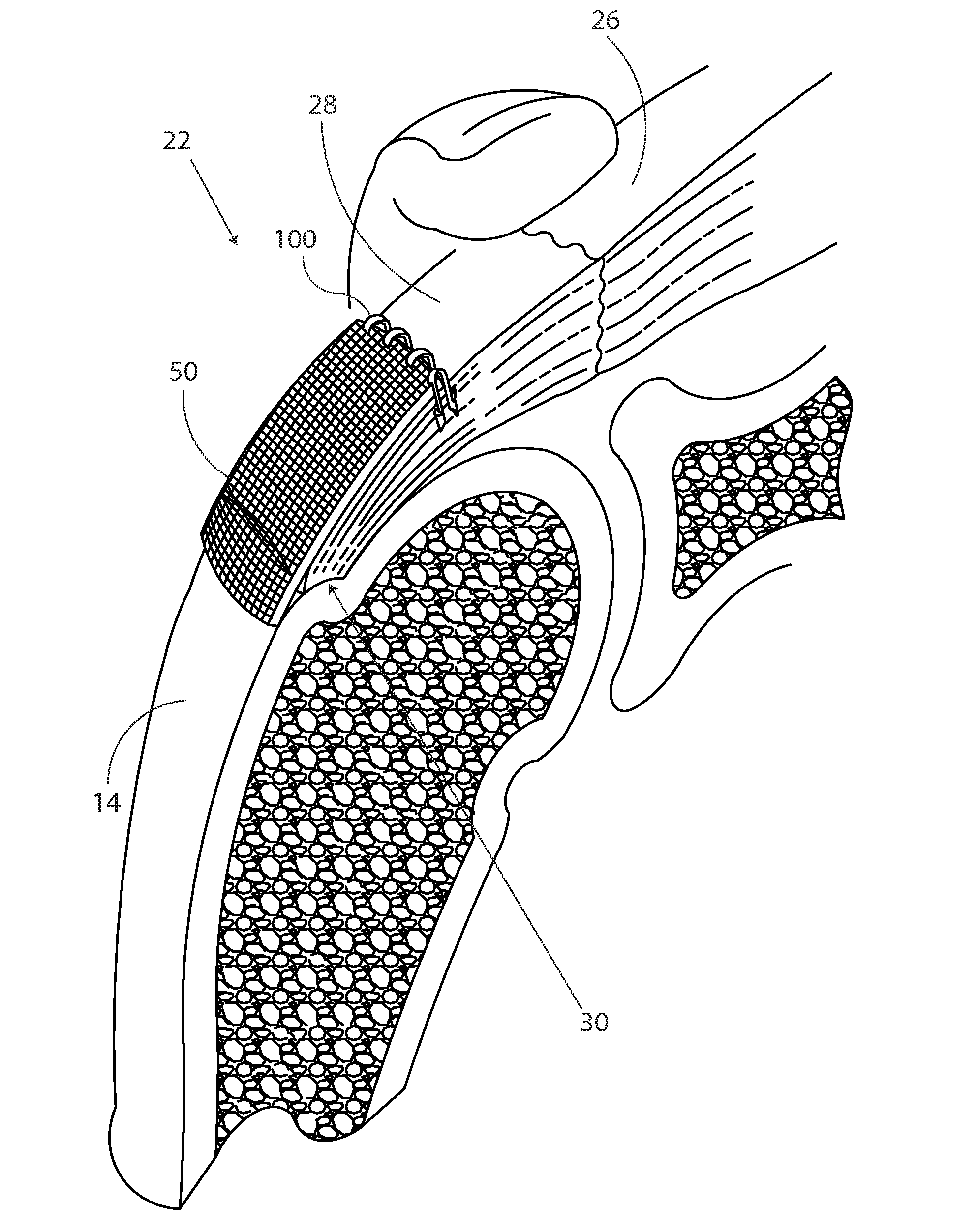 Methods and apparatus for fixing sheet-like materials to a target tissue