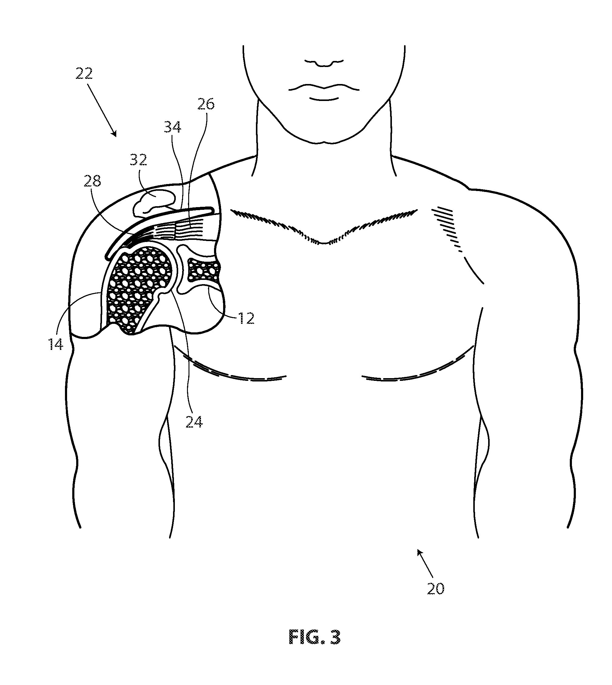 Methods and apparatus for fixing sheet-like materials to a target tissue